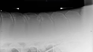 Kissing spines: Mange muligheter for forebygging og behandling